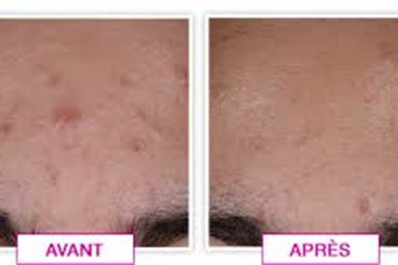 résultats deux mois d'utilisation